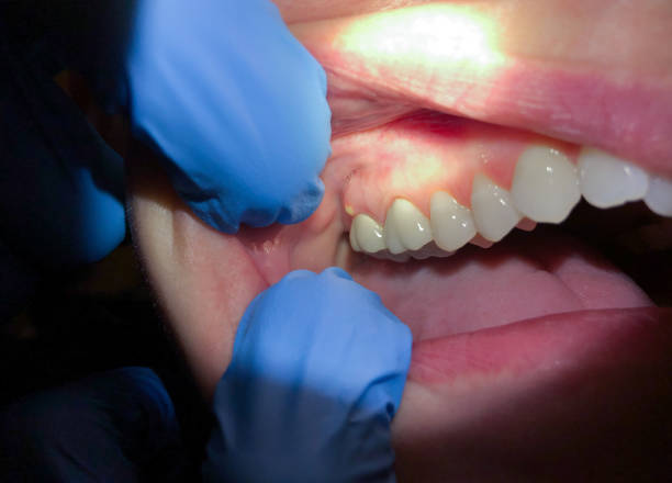 Best Dental Abscess Treatment in North Wantagh, NY